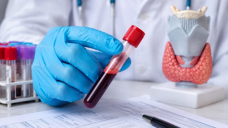 What Does TSH w/Reflex to FT4 Mean? Thyroid Results Explained 